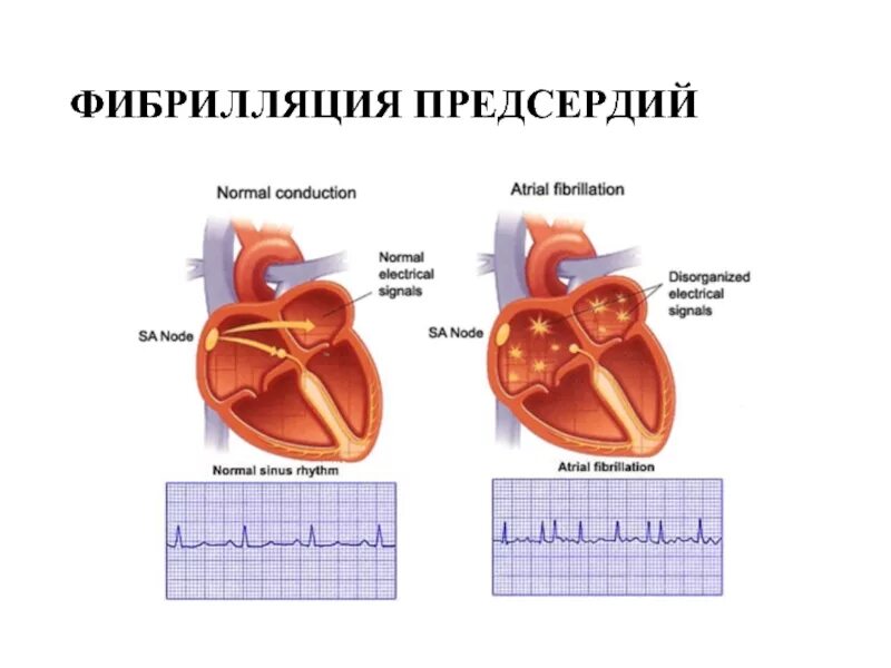 Фибрилляция предсердий. НРС фибрилляция предсердий. Неклапанная фибрилляция предсердий. Пароксизмальная фибрилляция предсердий. Предсердие болезни