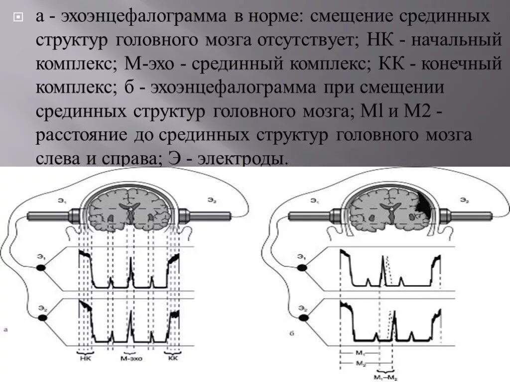 Срединные структуры головного мозга на ЭЭГ. Неспецифические срединные структуры головного мозга что это. Смещение срединных структур головного мозга. Дисфункция срединных структур головного мозга. Неспецифические изменения головного мозга