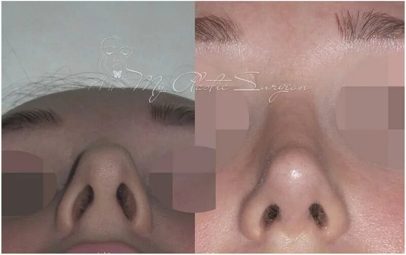 Абдоминопластика до и после. Гименопластика до после фот. Липофилинг живота до и после. Гименопластика до и после. Гименопластика до и после.