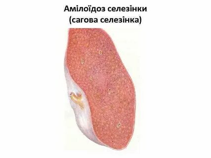 Саговый амилоидоз