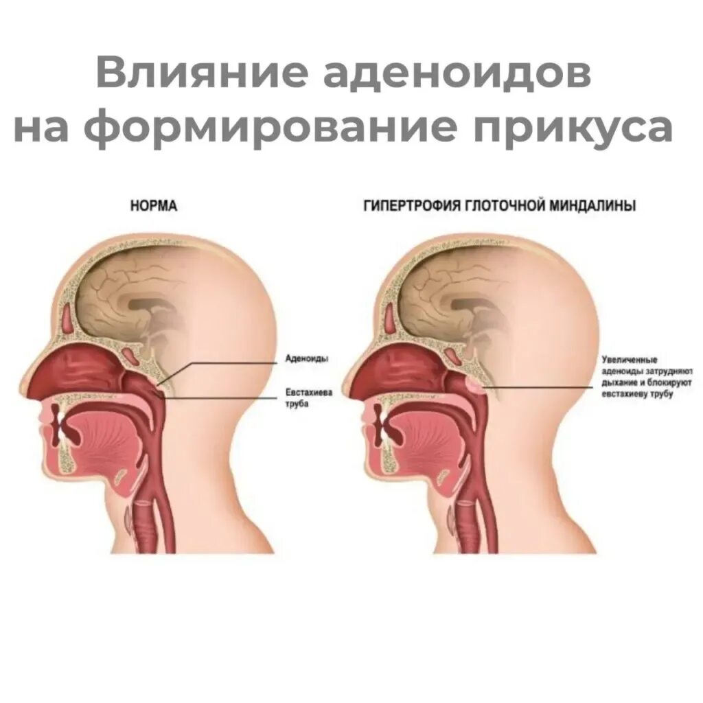 Аденоидные вегетации 1. Носоглоточная миндалина. Аденоиды носоглоточные миндалины.