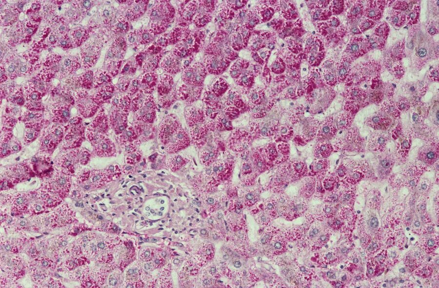 Стволовые клетки печени. Liver Cell. Ямочные клетки печени. Печеночно-клеточная аденома. Liver Hystology Cells.