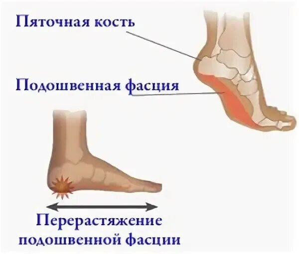 Пяточная шпора мкб