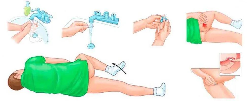 введение суппозитория (свечи) в прямую кишку. как правильно ввести свечку. как правильно вводить свечи ректально ребенку 2 года. как правильно ввести свечку. что такое ректальное введение свечей.