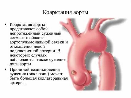 Врожденный порок аорты