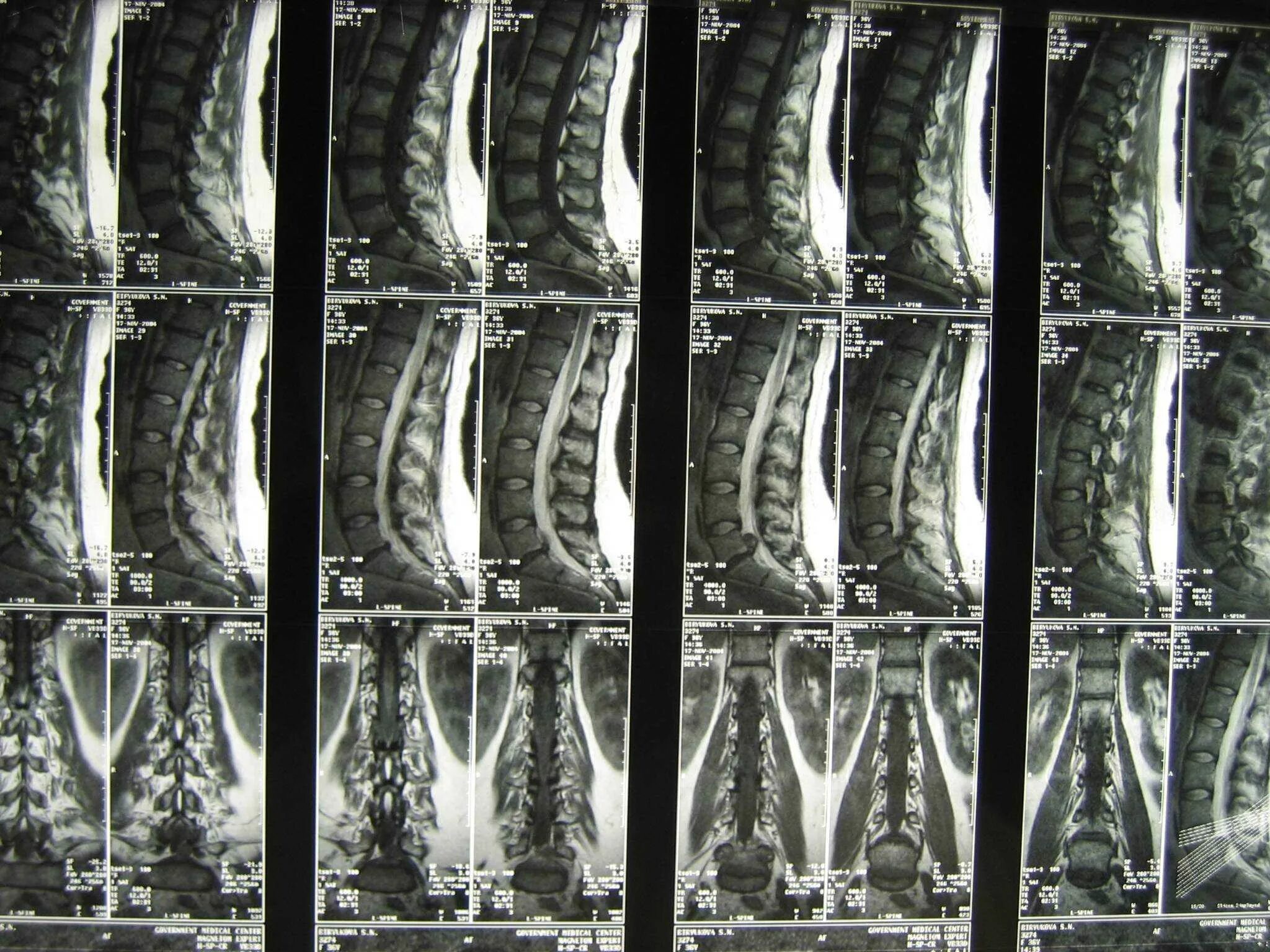 Мрт спинного отдела. Гиперлордоз поясничного отдела мрт. Мрт грыжи поясничного отдела позвоночника. Грыжа позвоночника поясничного отдела на кт. Остеохондроз поясничного отдела позвоночника мрт.