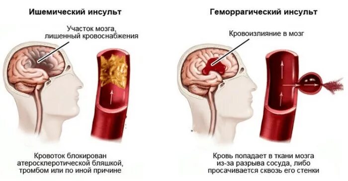 Инсульт барнаул. Осложнения ишемического инсульта. Ишемический инсульт головного мозга клиника. Основные симптомы ишемического инсульта. Осложнения геморрагического инсульта.