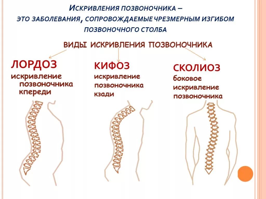 Болит позвоночник у ребенка. Нарушение осанки кифоз сколиоз. Искривление позвоночника лордоз. Искривление позвоночника кифоз и лордоз. Позвоночник заболевания кифоз лордоз.