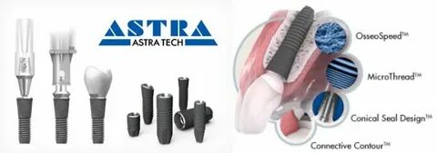 Astra имплант отзывы