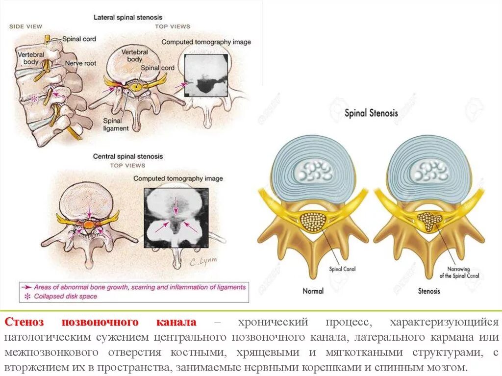 Сужение латерального кармана позвоночного канала. Латеральный стеноз на уровне l5-s1. Ширина позвоночного канала измерение кт. Латеральный карман позвоночного канала кт.