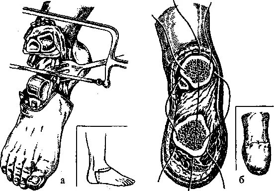 Костно пластическая ампутация Пирогова. Костно-пластическая ампутация стопы по Пирогову. Костно-пластическая ампутация бедра по Гритти-Шимановскому. Костно пластическая ампутация голени по Пирогову.