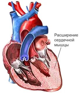 Расширение аорты сердца