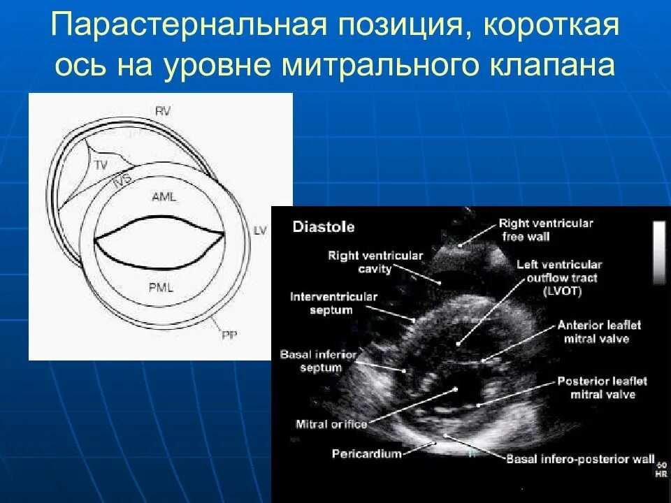 Гипокинез базального сегмента