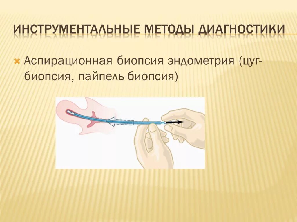 Биопсия эндометрия как делают. Техника выполнения пайпель биопсии эндометрия. Пайпель биопсия гистология. Аспирационная пайпель биопсия эндометрия. Пайпель биопсия протокол операции.