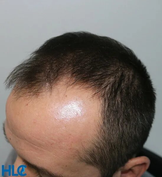 лысина впереди