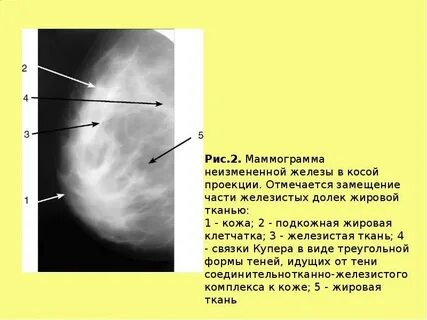 Что означает фиброзная ткань