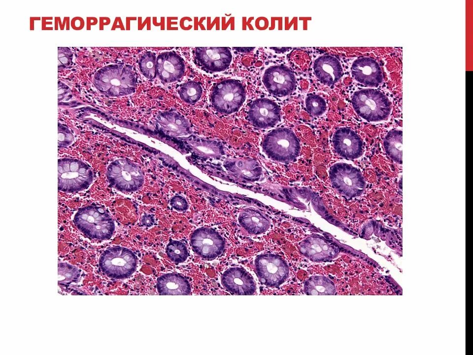 Геморрагическое воспаление патанатомия. Геморрагическое воспаление экссудат. Геморрагический гастрит микропрепарат.