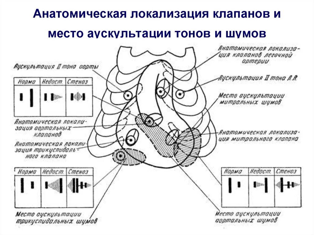 Сердечные тоны шумы. Схема прослушивания тонов сердца. Аускультация сердца схема тонов. Изображение соотношения тонов на разных точках аускультации сердца. Прослушивание клапанов сердца схема.