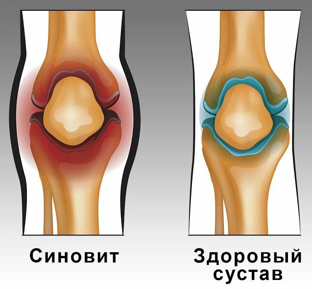 Выраженный синовит