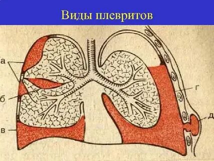 Гнойный плеврит