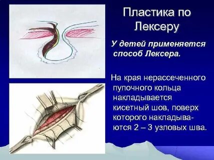Пупочная грыжа методы операции