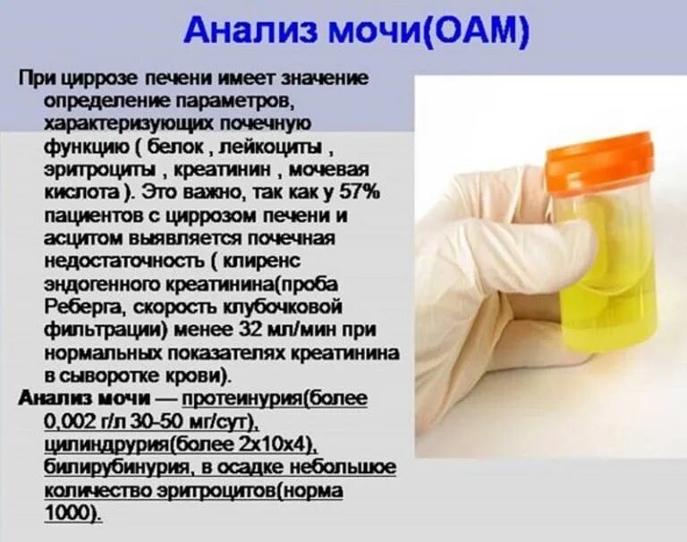 Какого цвета моча при циррозе. Общий анализ мочи при гепатите и циррозе. общий анализ мочи при циррозе печени. моча при циррозе печени. оам при циррозе печени.
