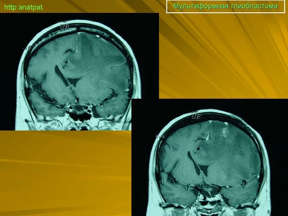 Мультиформная глиобластома. Мультиформная глиобластома мрт. Мультиформная глиобластома осложнения. Глиобластома операция.