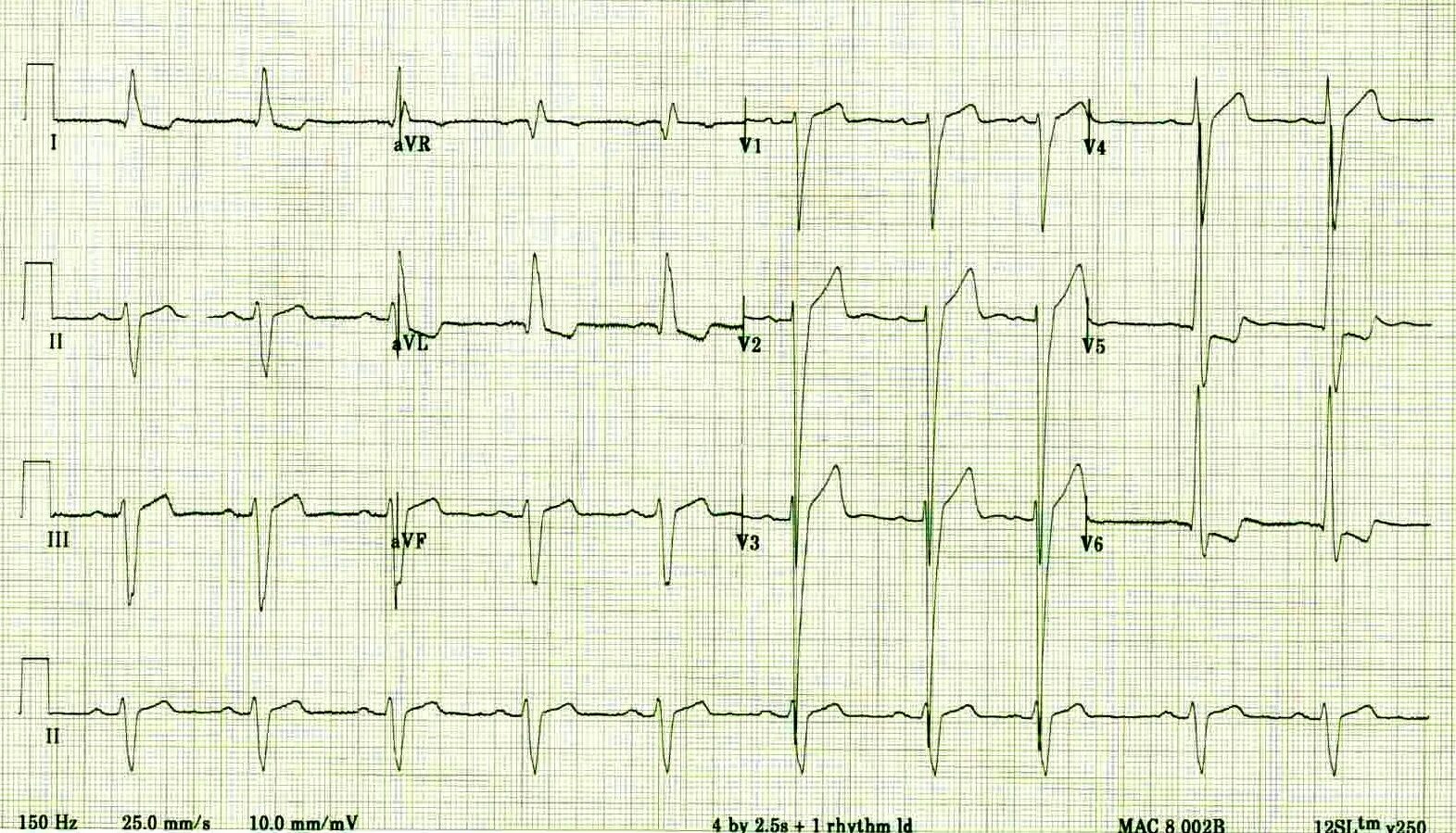 Альтернация QRS на ЭКГ. Электрическая альтернация на ЭКГ. Альтернация зубцов QRS комплекса. Альтернация зубцов на ЭКГ что это.