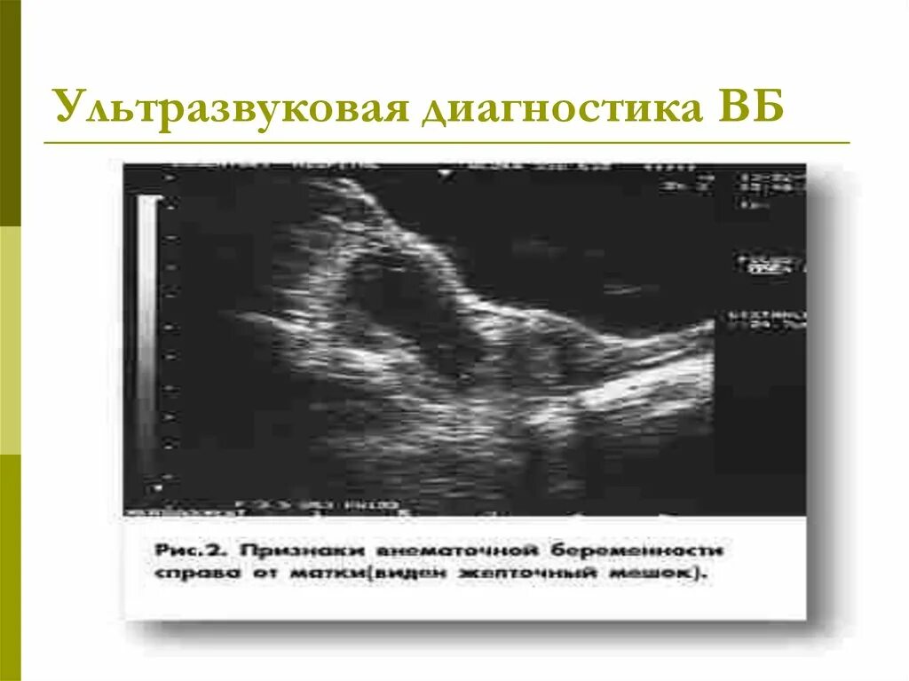 трубная беременность узи. шеечная беременность узи. внематочная беременность снимки узи. внематочная беременность 2-3 недели на узи. узи признаки трубной беременности.