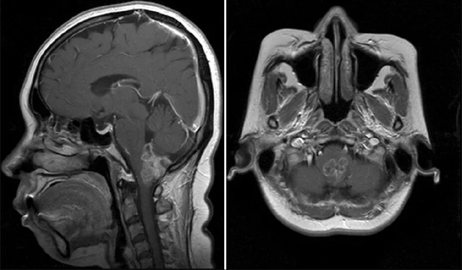 Глиома ствола головного. Глиома ствола головного мозга мрт. Глиома головного мозга кт. Глиома головного ствола