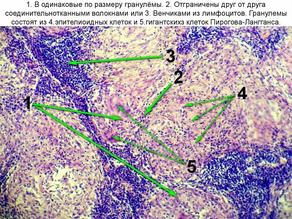 Эпителиоидные клетки гистология. Гистология ангиофолликулярная гиперплазия. Реактивная гиперплазия лимфатического узла гистология. Эпителиоидные клетки гранулемы. Реактивная гиперплазия лимфоузла
