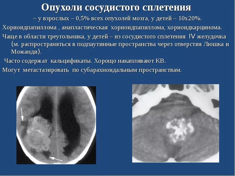 Базальная опухоль
