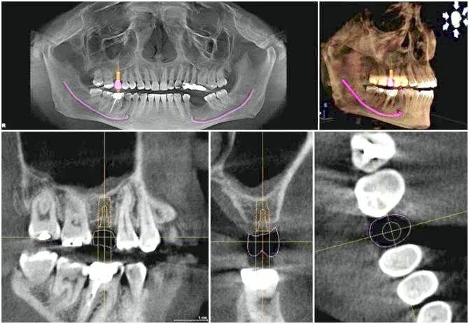 Киста зуба на кт снимке. Радикулярная киста верхней челюсти кт. Кт верхней челюсти коста зуба. Киста пазухи верхней челюсти кт. Как выглядит киста на кт.