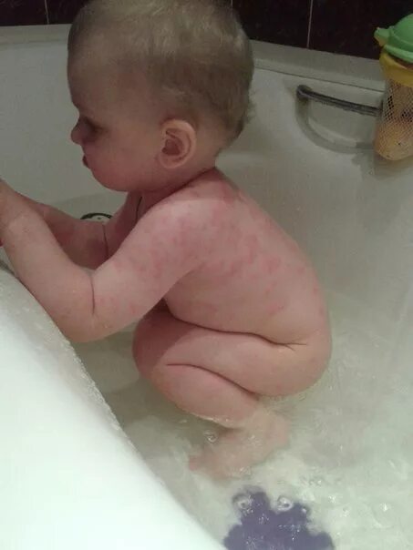 Температура после ванны. Раздражение на коже у младенца. Аллергия у ребенка на подгузники.