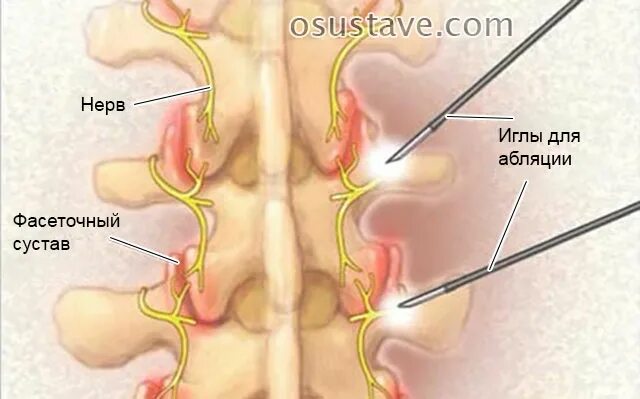 Фасеточная блокада. Радиочастотная денервация фасеточных суставов шейного отдела. Радиочастотная деструкция фасеточных суставов поясницы. Радиочастотная деструкция фасеточных нервов. Денервация фасеточных суставов позвоночника.