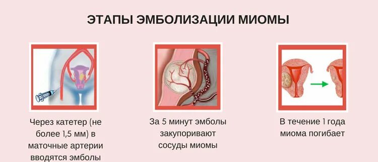 Эма миомы матки