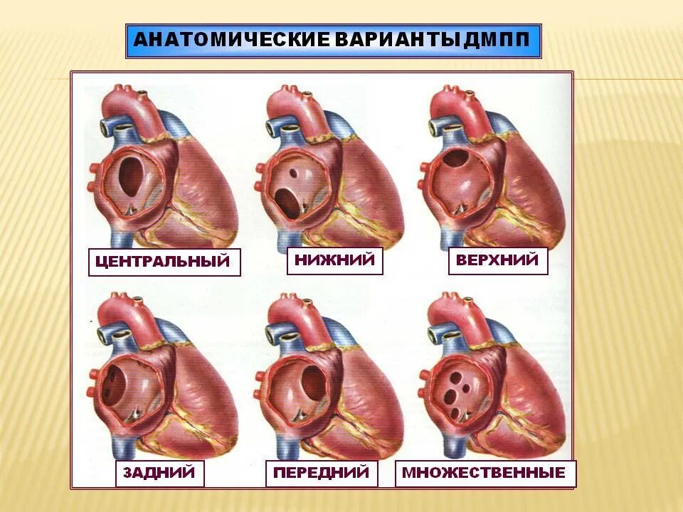 Порок сердца дмпп. Дефект мпп сердца у ребенка. перимембранозный дмжп. порок сердца межпредсердной перегородки.