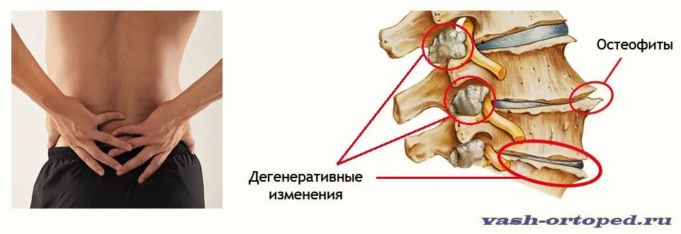 Спондилеза спондилоартроза поясничного отдела позвоночника. Спондилёз грудного отдела позвоночника симптомы. Остеохондроз спондилез спондилоартроз. Спондилез.остеохондроз пояснично-крестцового отдела позвоночника. Остеохондроз спондилоартроз спондилез позвоночника поясничного.