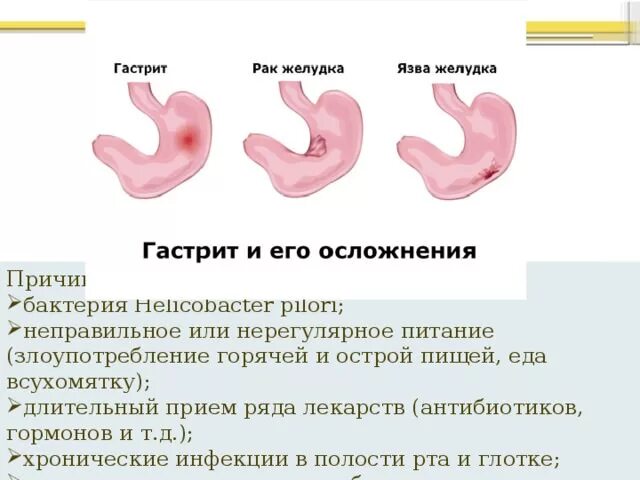 Хронический гастродуоденит осложнения. Острый и хронический гастрит. Гастрит причины возникновения.