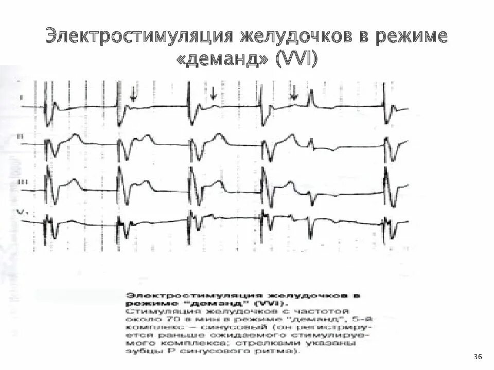 Блокада желудочков на экг. Внутрижелудочковая блокада левой ножки пучка гиса экг. Этиология, клиника нарушения внутрижелудочковой проводимости. Нарушение внутрижелудочковой проводимости на экг. Проводимость желудочков.