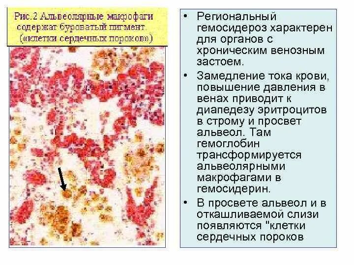 Клетки сердечных пороков в мокроте. Гемосидероз альвеолярных макрофагов. Микроскопическое исследование мокроты альвеолярные макрофаги.