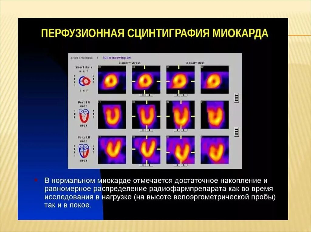 Исследование изотопами. Сцинтиграфия миокарда проекция. Радиоизотопная сцинтиграфия миокарда. Перфузионная сцинтиграфия при стенокардии. Перфузионная сцинтиграфия миокарда при ИБС.