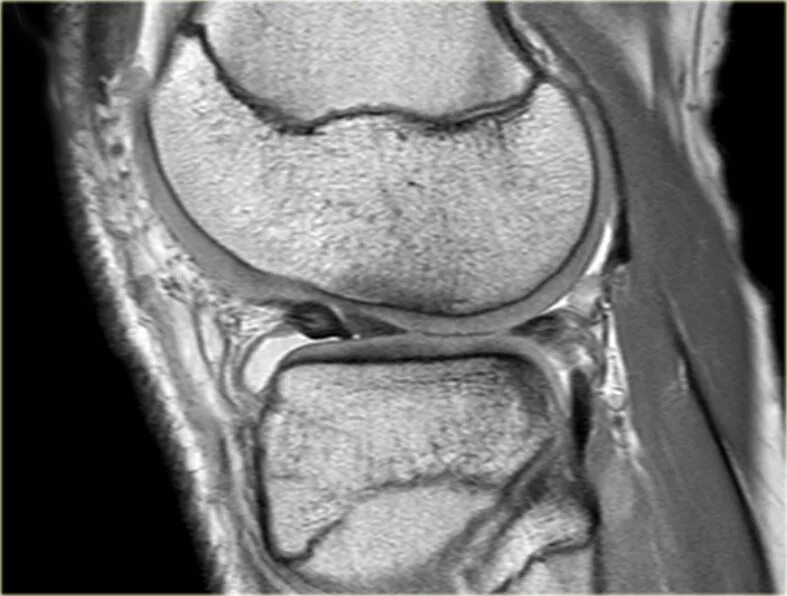 Разрыв мениска мрт. Мрт коленного сустава разрыв мениска. Разрыв корня мениска мрт. Паракапсулярный разрыв мениска мрт. Повреждение мениска коленного сустава мрт.
