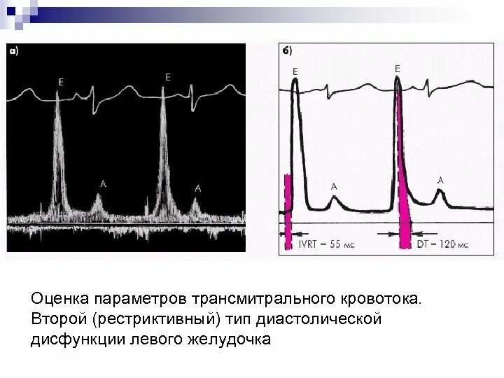 IVRT диастолическая дисфункция ЭХОКГ. Псевдонормальный Тип диастолической дисфункции левого желудочка. Рестриктивный Тип диастолической дисфункции. Оценка диастолической дисфункции.