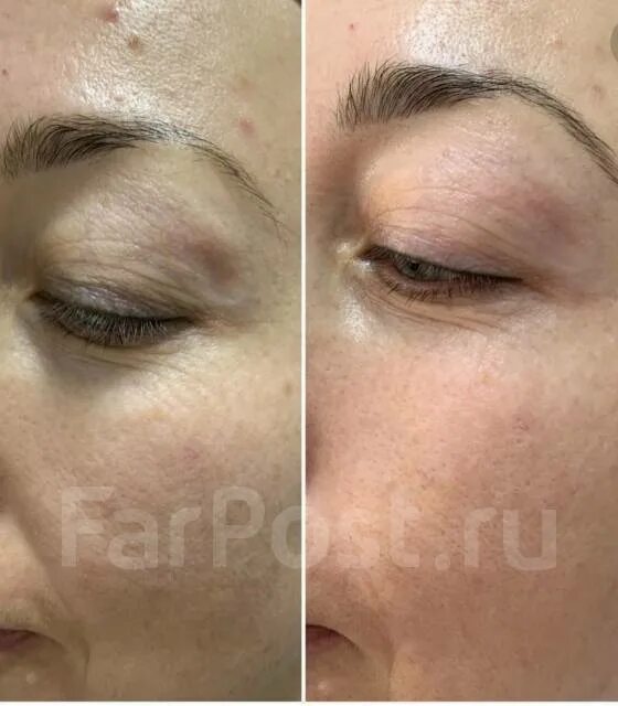 Бмс лица до и после БМС мышц лица До и После Центр Эстетики Лица и Тела