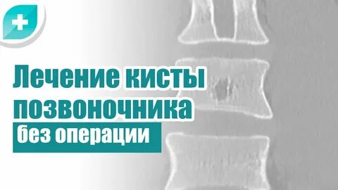 Лечение кисты спб