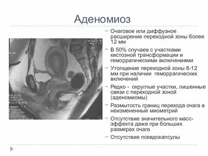 Эхо аденомиоза