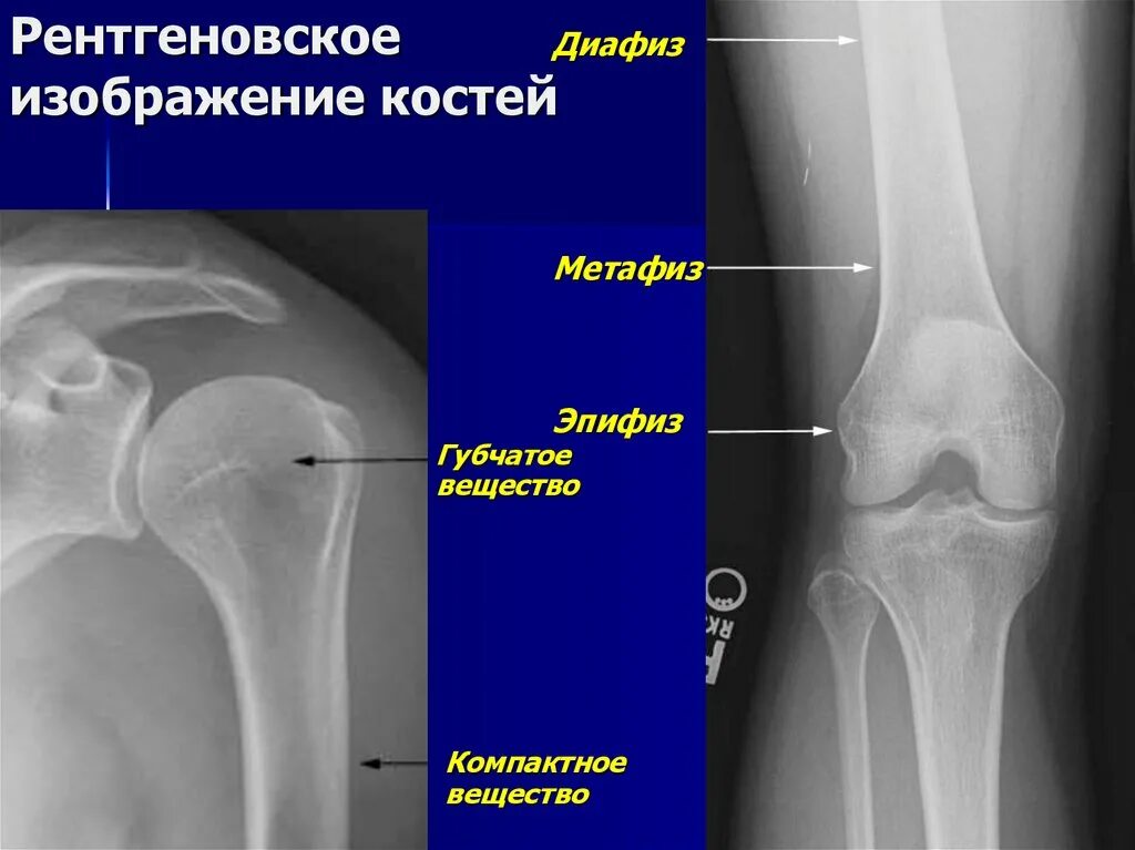 Какой сустав изображен. Метафиз бедренной кости рентген. Эпифиз и диафиз кости. Дистальный метафиз большеберцовой кости. Диафиз эпифиз метафиз переломы.