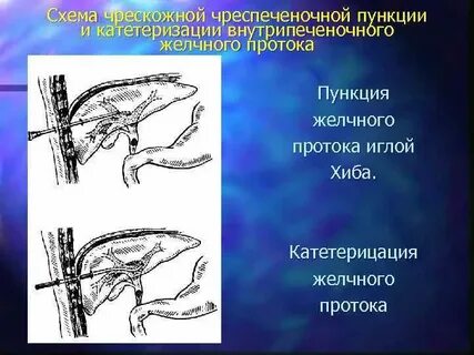 Дренирование желчных протоков