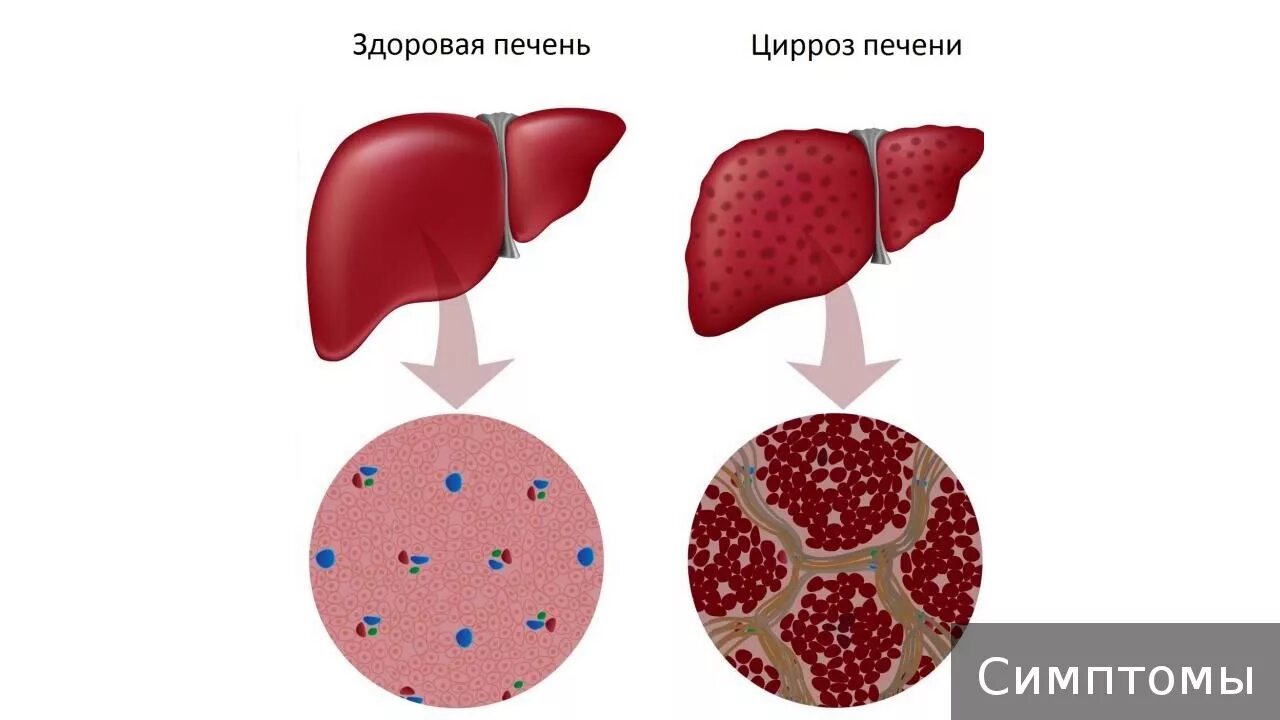 Цирроз у алкоголиков симптомы